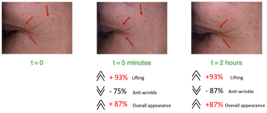 Lifting and “wrinkle eraser” effects of Tens’ upTM  in 5 mins and in 2 hrs.